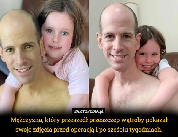 
    Mężczyzna, który przeszedł przeszczep wątroby pokazał swoje zdjęcia przed