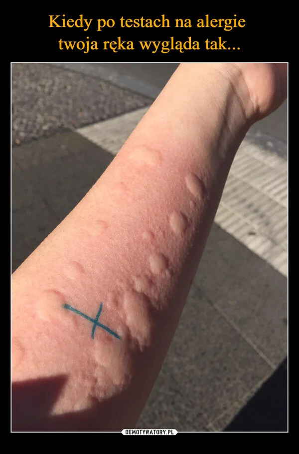 Kiedy po testach na alergie twoja ręka wygląda tak...