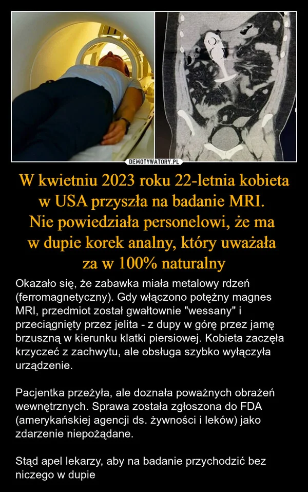 W kwietniu 2023 roku 22-letnia kobieta w USA przyszła na badanie MRI. Nie powiedziała personelowi, że ma w dupie korek analny, który uważała za w 100% naturalny