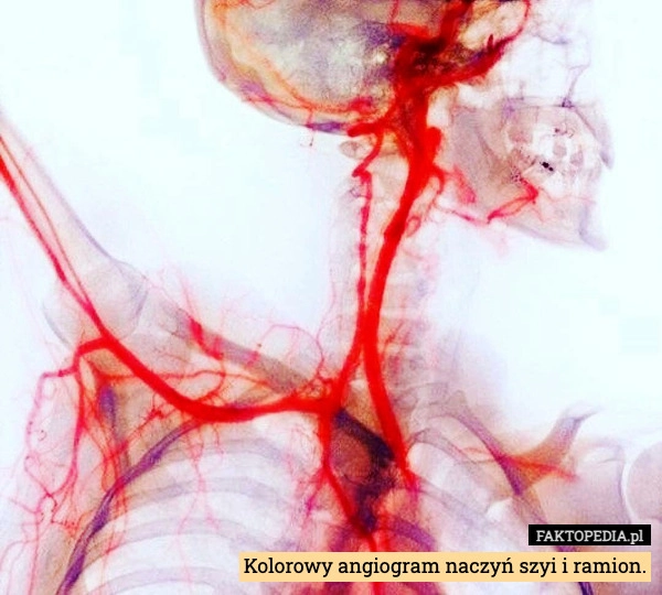 
    Kolorowy angiogram naczyń szyi i ramion.