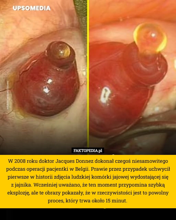 
    W 2008 roku doktor Jacques Donnez dokonał czegoś niesamowitego podczas operacji