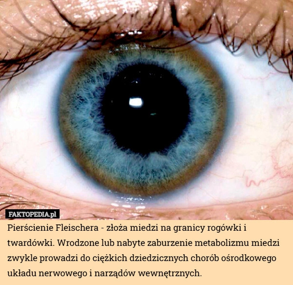
    Pierścienie Fleischera - złoża miedzi na granicy rogówki i twardówki. Wrodzone