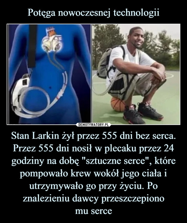 
    
Potęga nowoczesnej technologii Stan Larkin żył przez 555 dni bez serca. Przez 555 dni nosił w plecaku przez 24 godziny na dobę "sztuczne serce", które pompowało krew wokół jego ciała i
utrzymywało go przy życiu. Po znalezieniu dawcy przeszczepiono
mu serce 